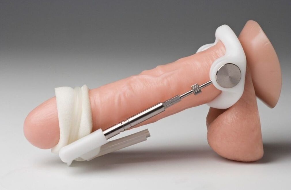 Espansione per aumentare lo spessore del pene